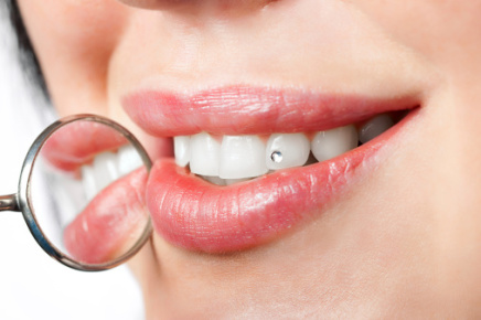 Zahnschmuck ist in der Zahnarztpraxis Zimmermann möglich